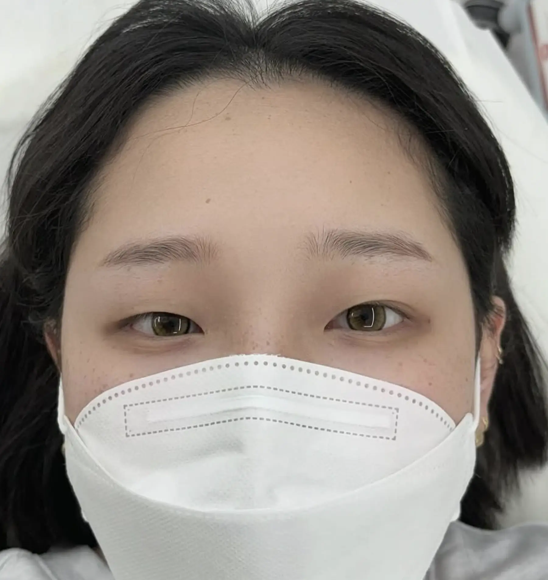 eyebrow tattoo removal